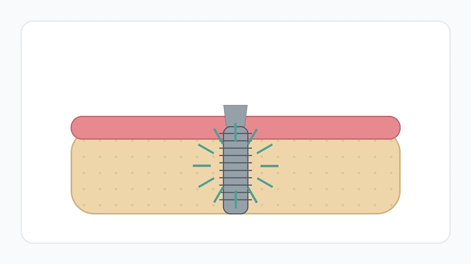 Dental implant surrounded by healing bone, illustrating osseointegration.