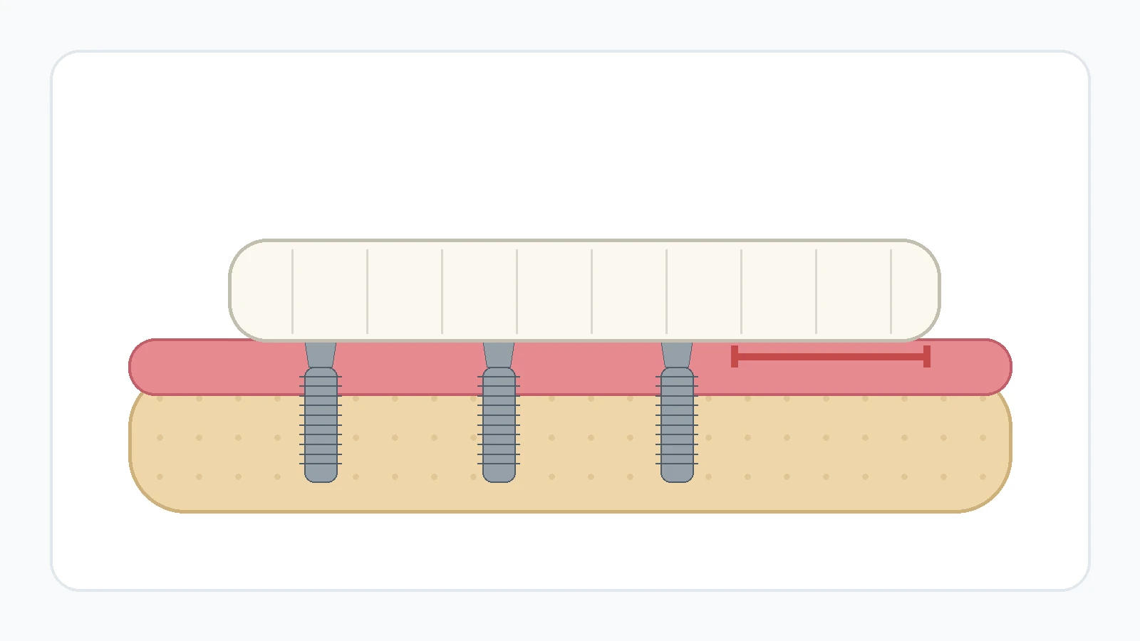 Full-arch implant bridge extending beyond the final supporting implant to illustrate a cantilever.