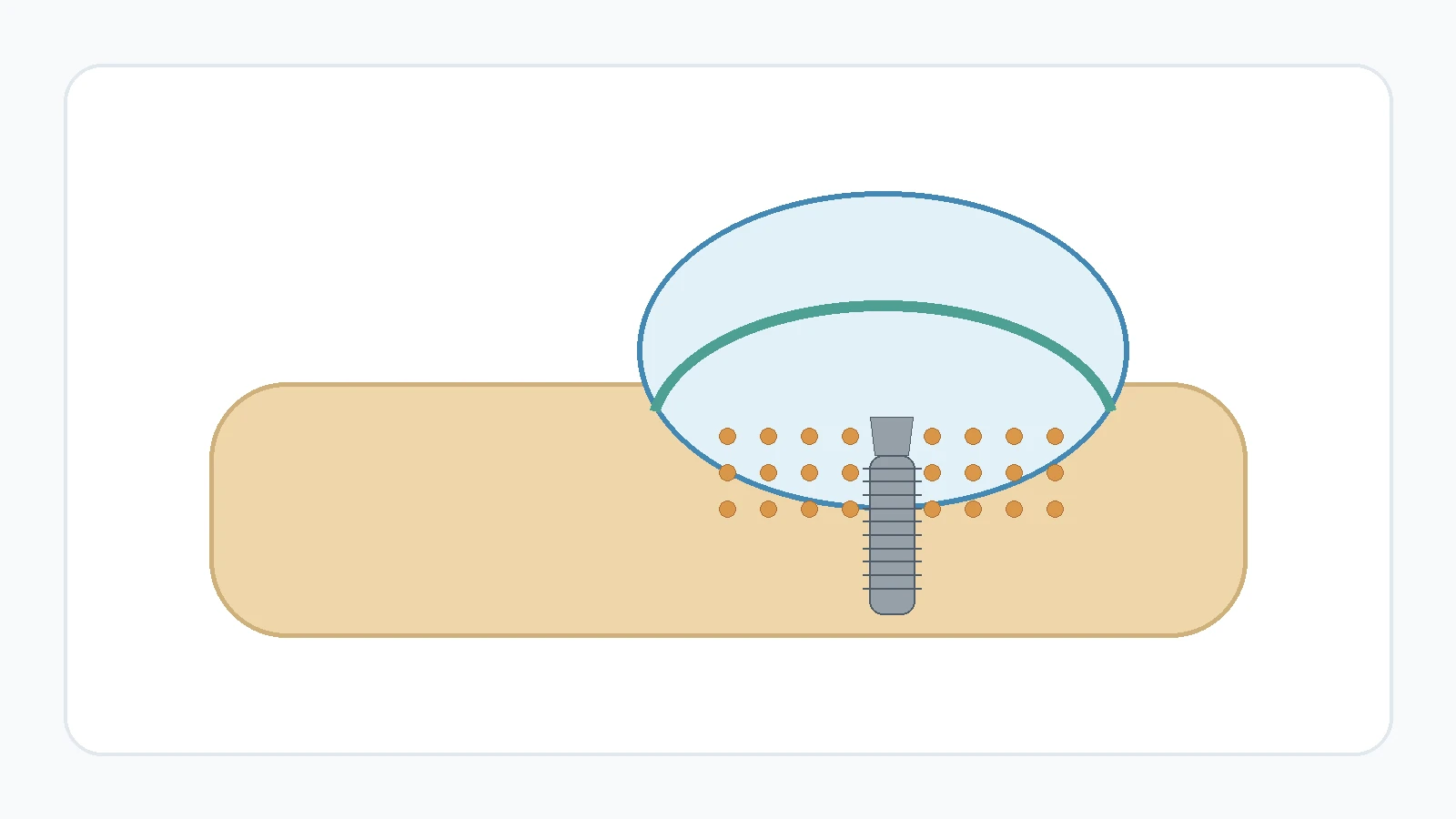 Cross-section showing a lifted sinus membrane with bone graft material beneath it and an implant.
